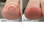 【riposo】3 types of Unfold Gel for ingrown toenails